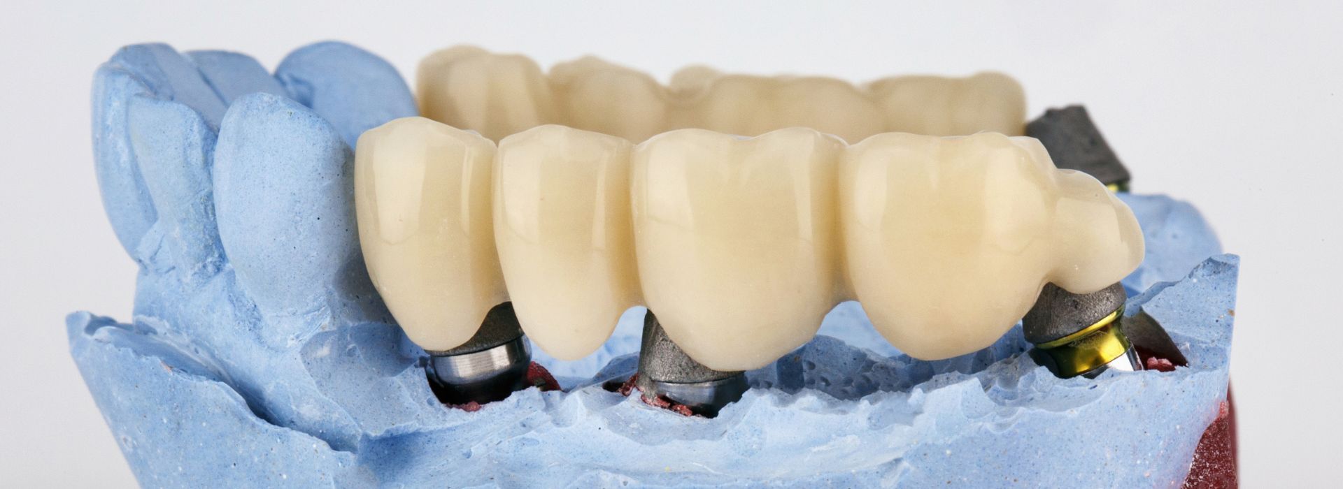 Dental Bridge