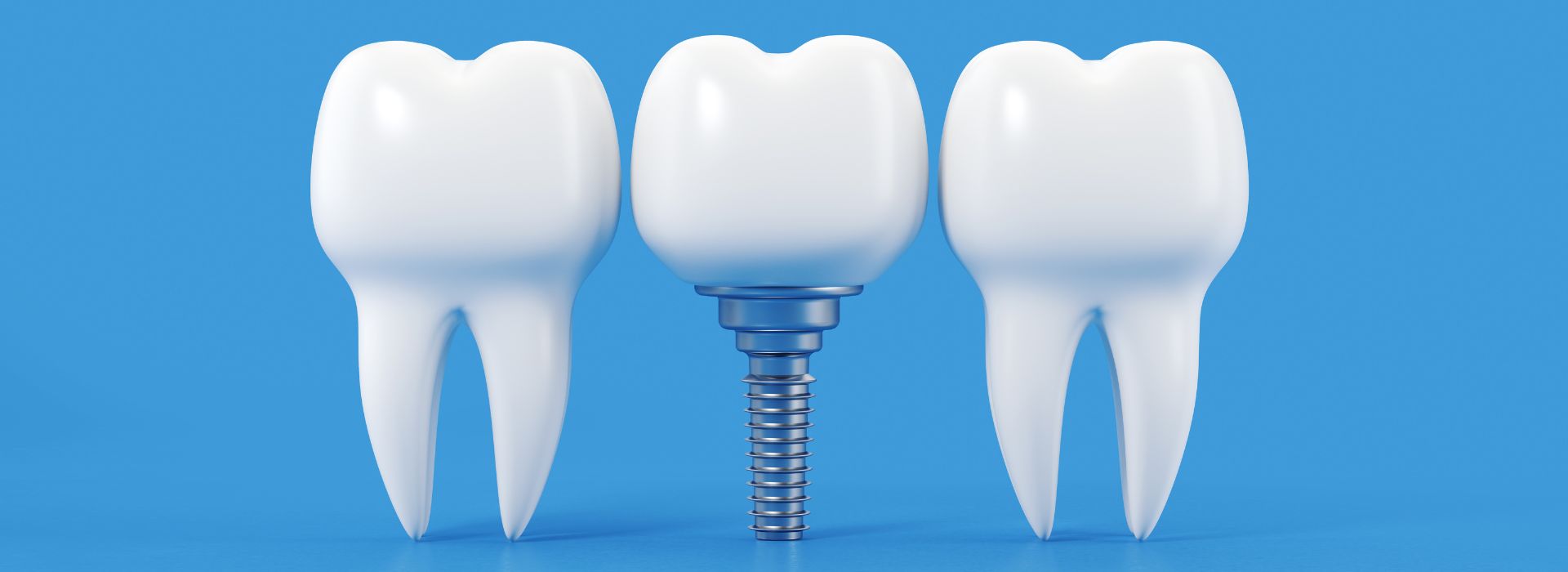 Dental Implant